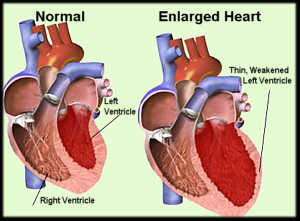  Cardiomegaly Causes Treatment Symptoms Pictures Types