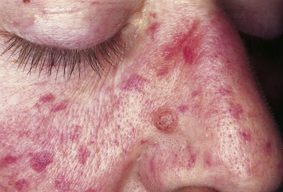 Hereditary Hemorrhagic Telangiectasia 2