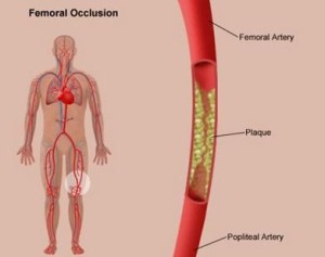 Intermittent claudication picture