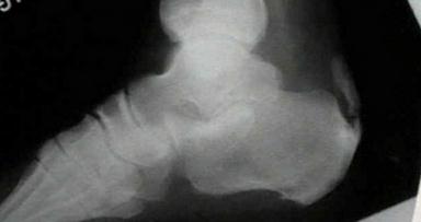 tears in the peroneal tendons